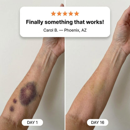 💥100K+ SOLD💕- Raulmn® Advanced Bruise Repair & Skin Strengthening Cream